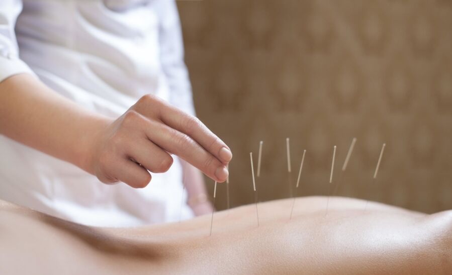 acupuncture